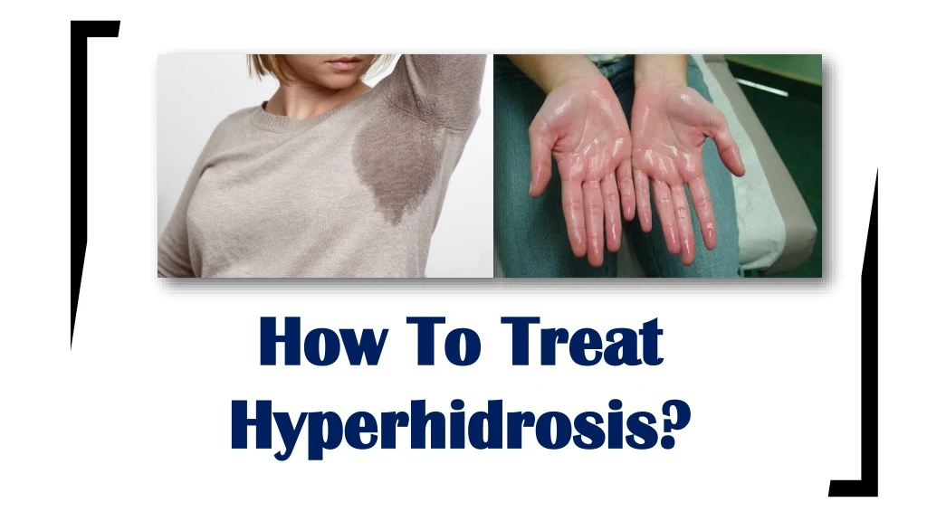 how to treat hyperhidrosis