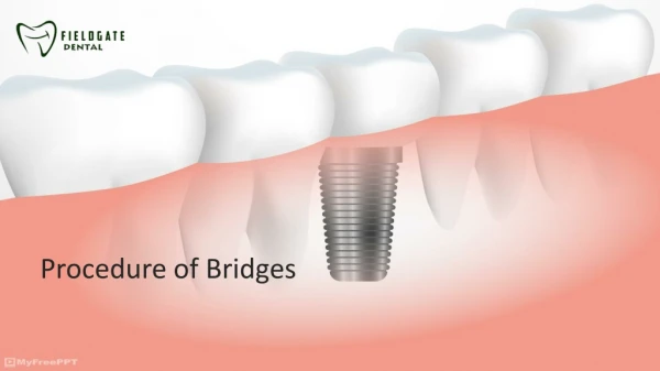 Procedures of Bridges - Fieldgate Dentistry