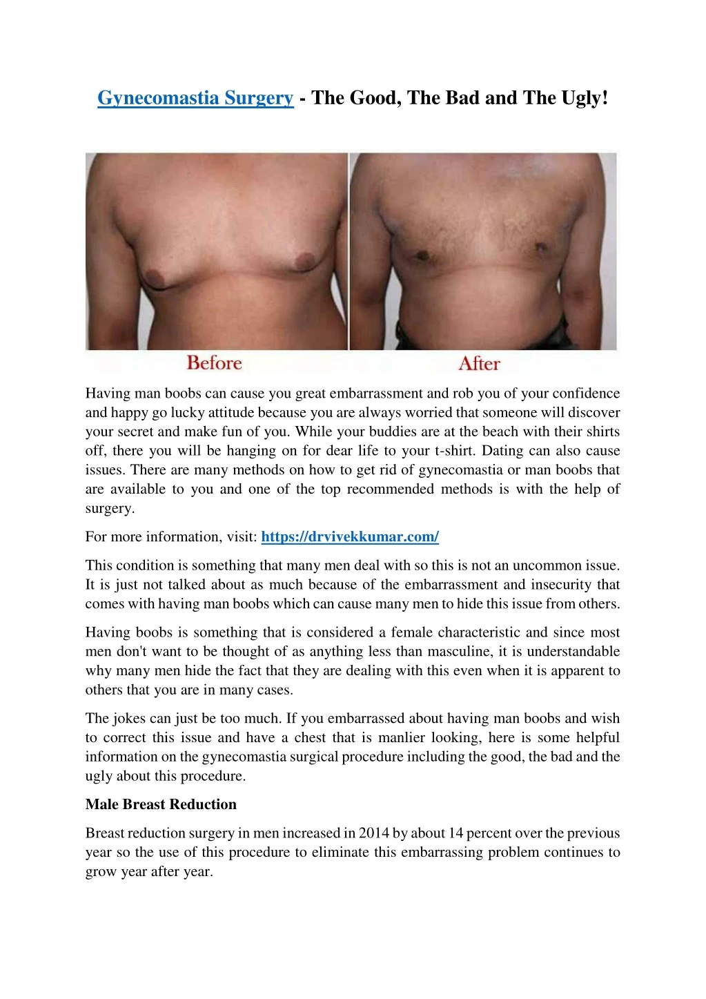 gynecomastia surgery the good the bad and the ugly