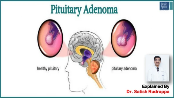 Pituitary Adenomas Symptoms, Treatment and Surgery | Pituitary Adenoma Treatment in Bangalore
