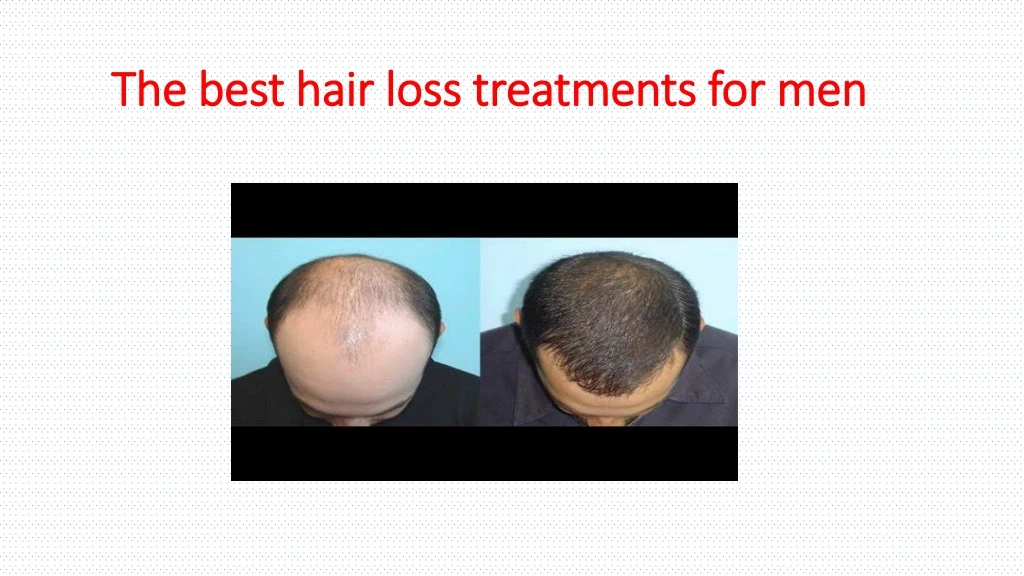 the best hair loss treatments for men