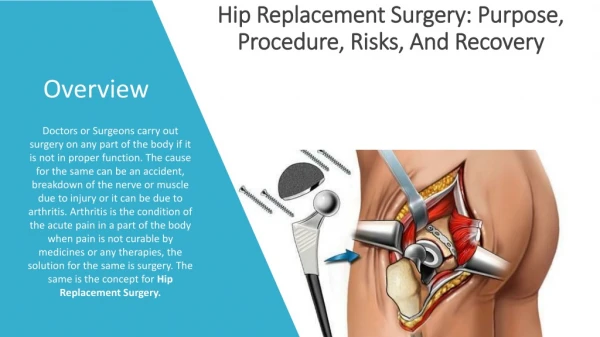 Hip Replacement Surgery: Purpose, Procedure, Risks, And Recovery