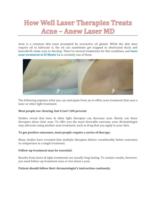 How Well Laser Therapies Treats Acne - Anew Laser MD