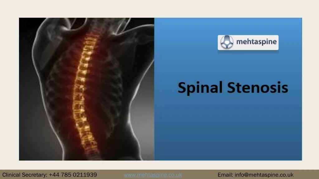 Ppt Spinal Stenosis Dr Jwalant S Mehta Powerpoint Presentation Free Download Id8345080 8033