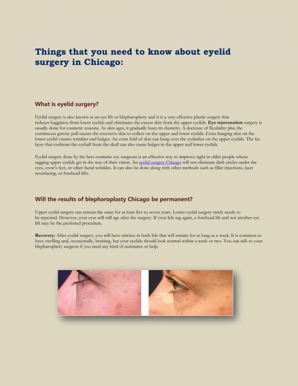 Things that you need to know about eyelid surgery in Chicago