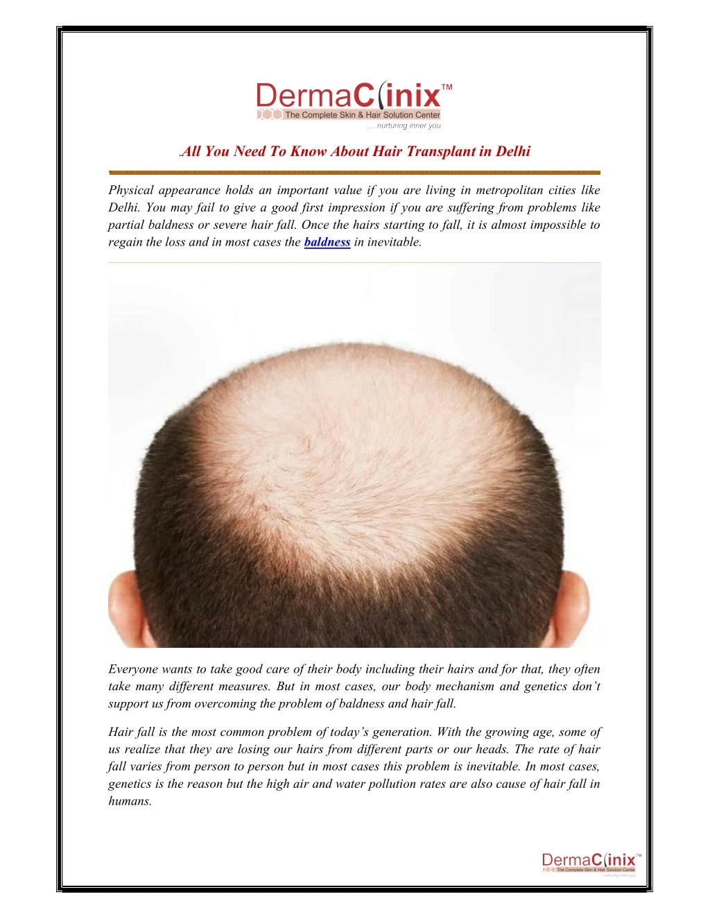all you need to know about hair transplant