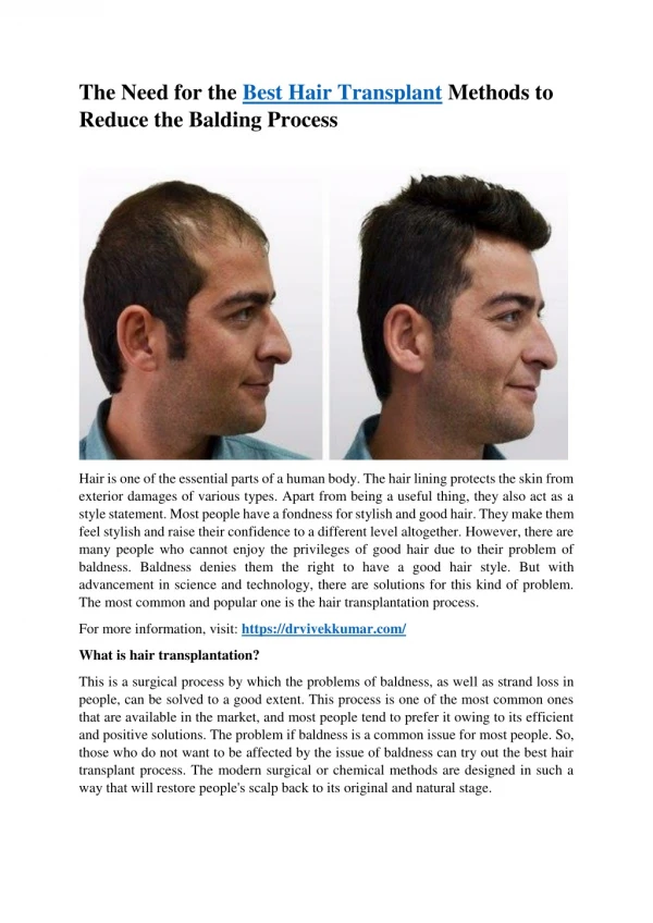 The Need for the Best Hair Transplant Methods to Reduce the Balding Process