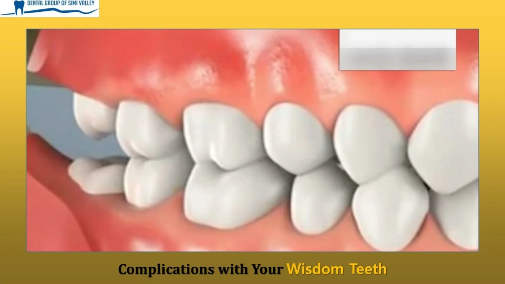 complications with your wisdom teeth