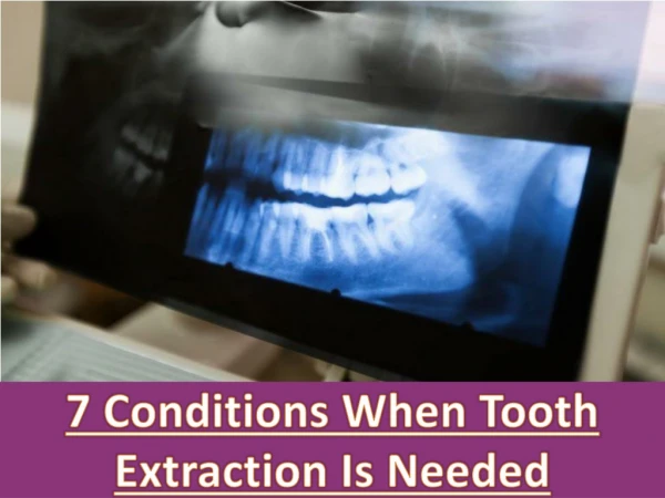 7 Conditions When Tooth Extraction Is Needed