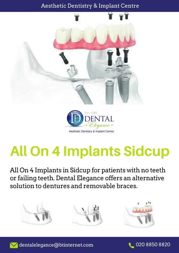 All On 4 Implants Sidcup