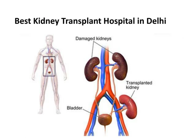 Best Kidney Transplant surgeon in Delhi