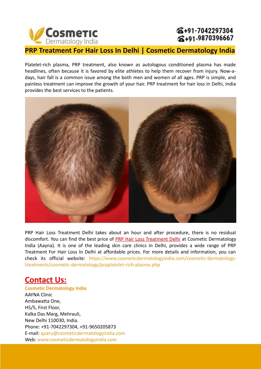 Ppt Prp Treatment For Hair Loss In Delhi Cosmetic Dermatology India