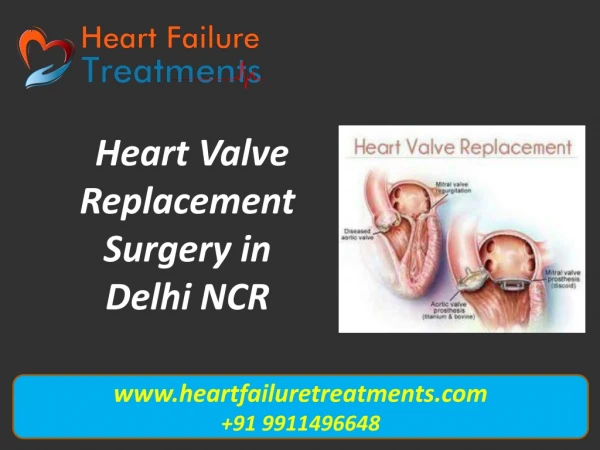 Heart Valve Replacement Surgery Cost in Delhi NCR | Heartfailuretreatments