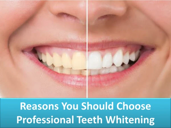 Reasons You Should Choose Professional Teeth Whitening