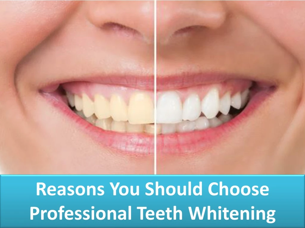 reasons you should choose professional teeth whitening