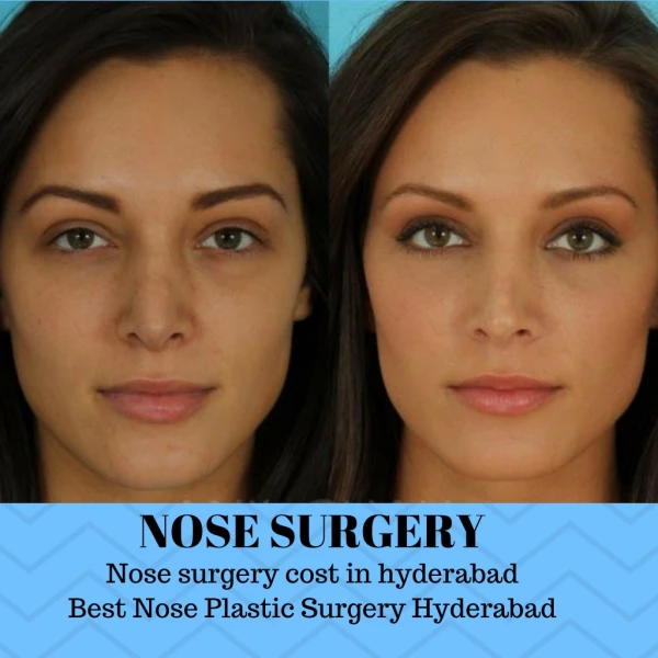 Nose surgery cost in hyderabad