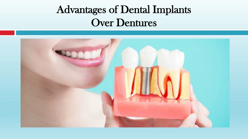 advantages of dental implants over dentures