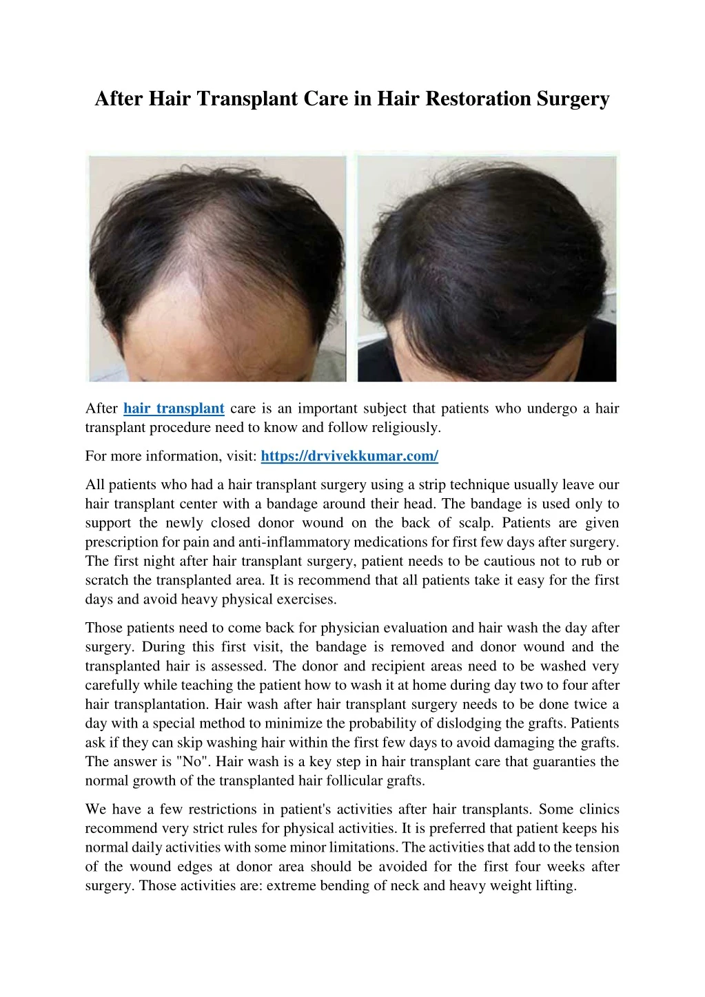 after hair transplant care in hair restoration