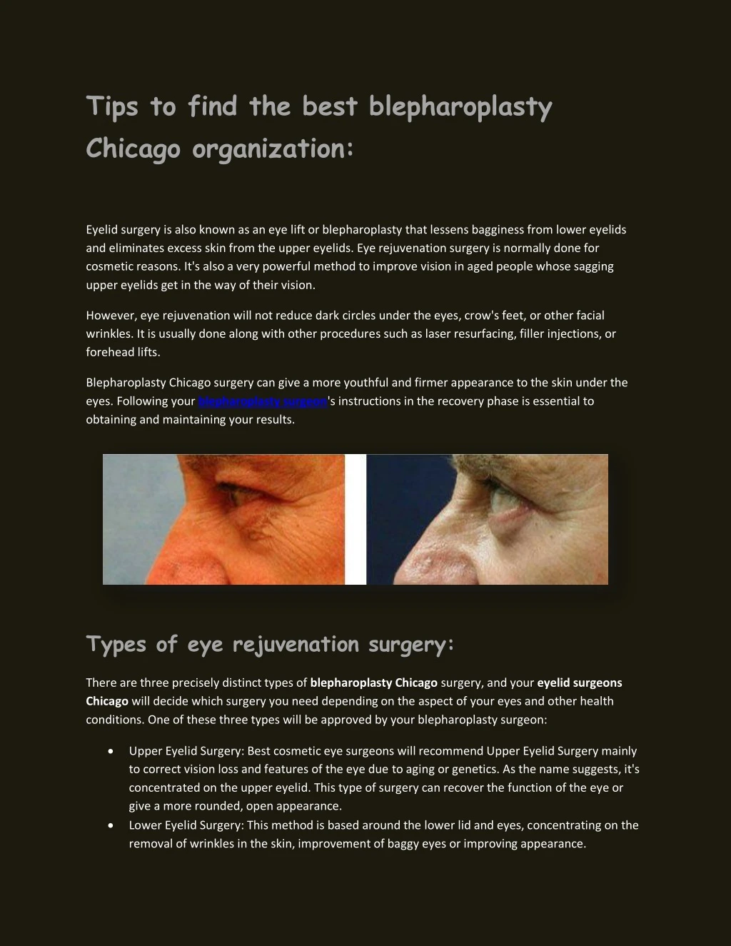 tips to find the best blepharoplasty chicago