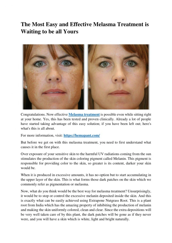 The Most Easy and Effective Melasma Treatment Is Waiting to be all Yours