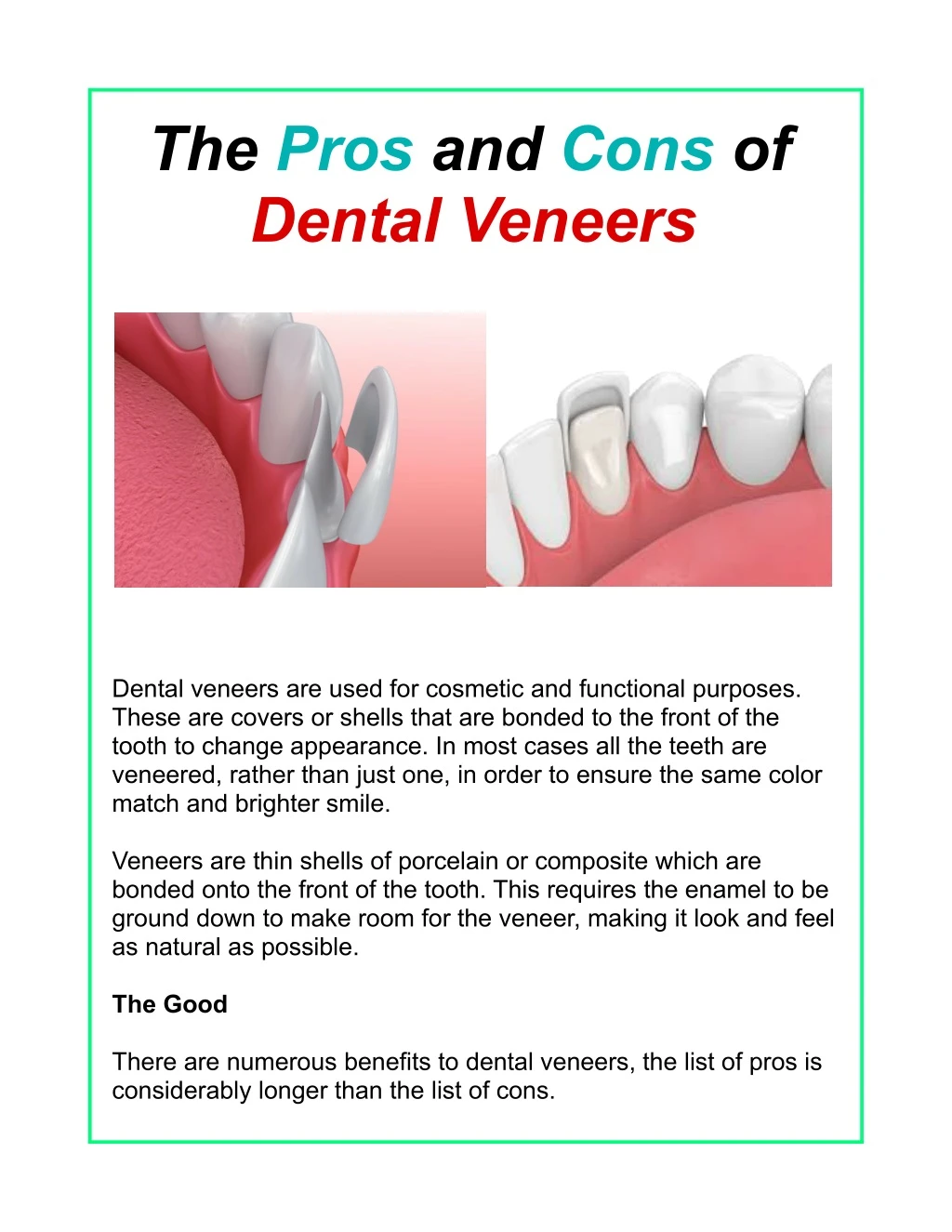 the pros and cons of dental veneers