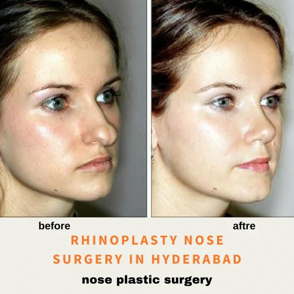 Rhinoplasty Nose Surgery In Hyderabad