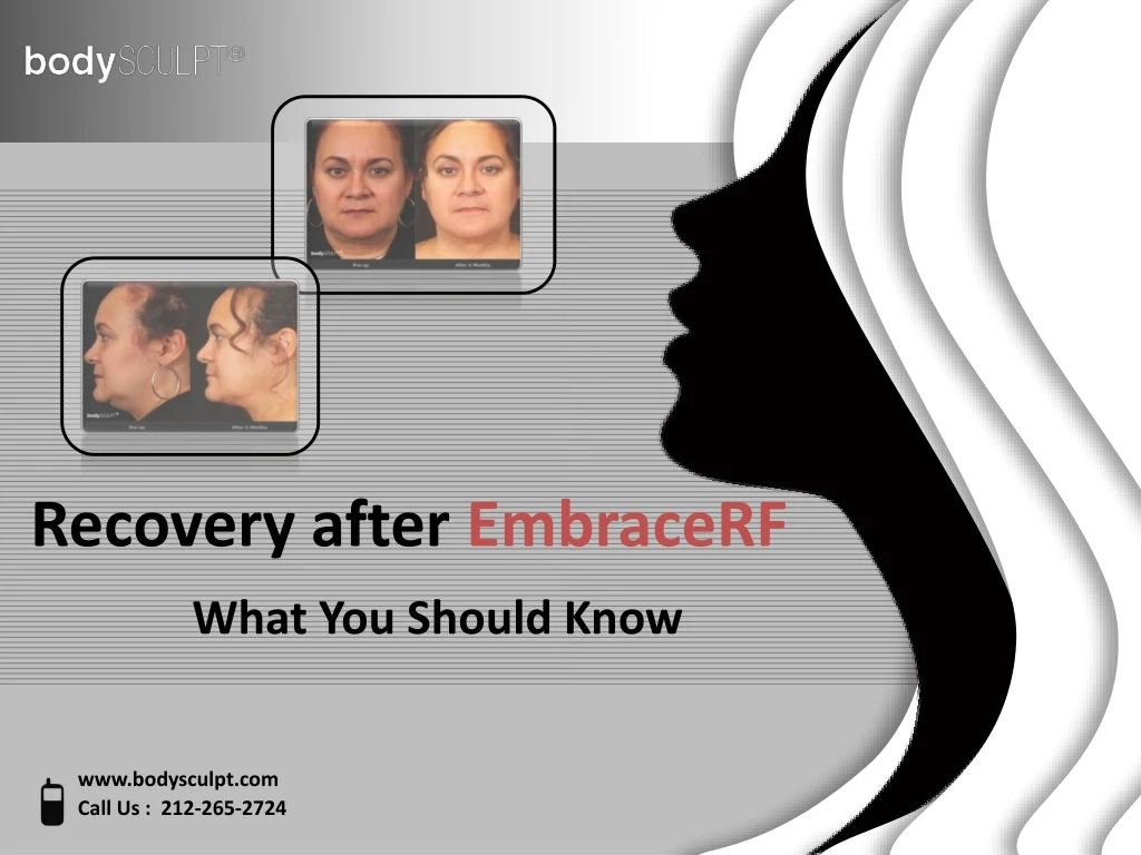 recovery after embracerf