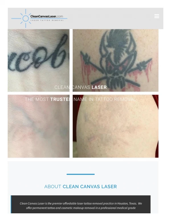 Laser Tattoo Removal in Huston Texas
