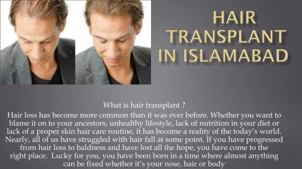 Hair transplant in Dubai | most effective for hairloss