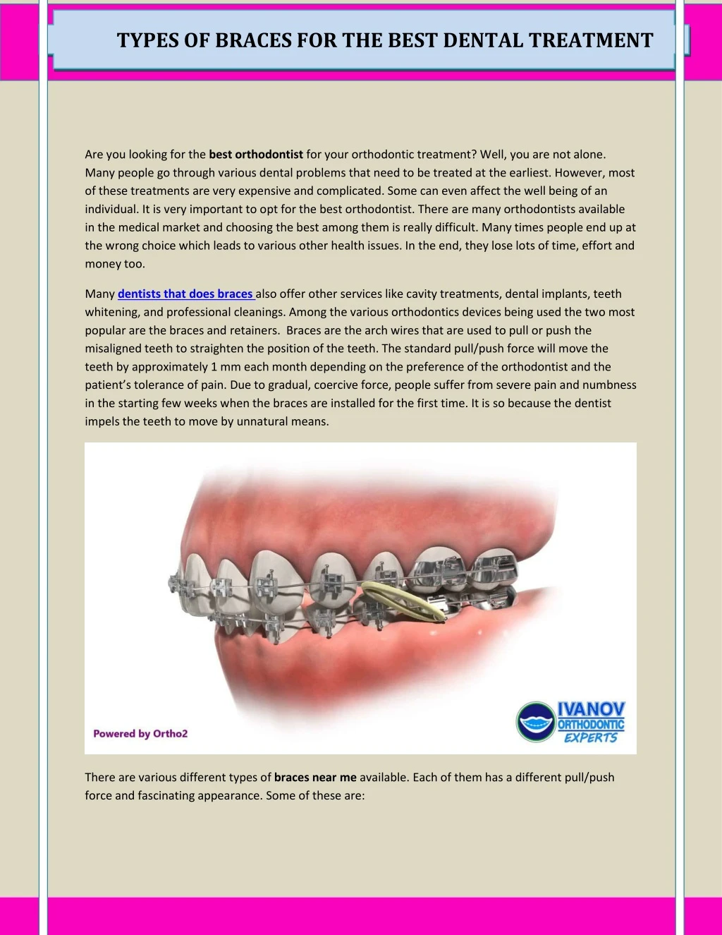 types of braces for the best dental treatment