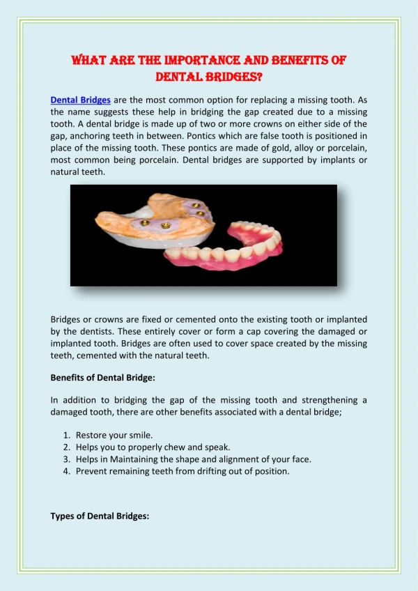 What are The Importance and Benefits of Dental Bridges