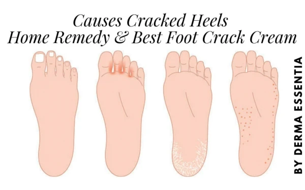 What Causes Cracked Heels - Home Remedy & Best Foot Crack Cream for That
