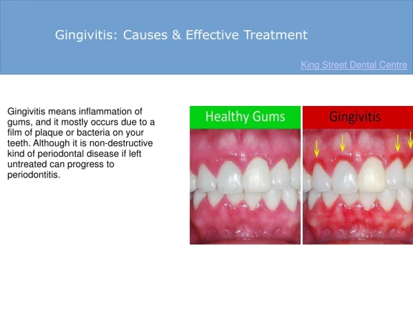 Gingivitis: Causes & Effective Treatment