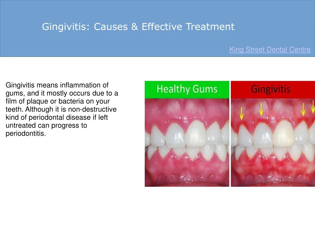 gingivitis causes effective treatment