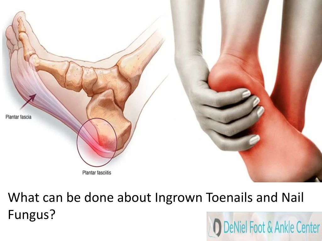 what can be done about ingrown toenails and nail fungus