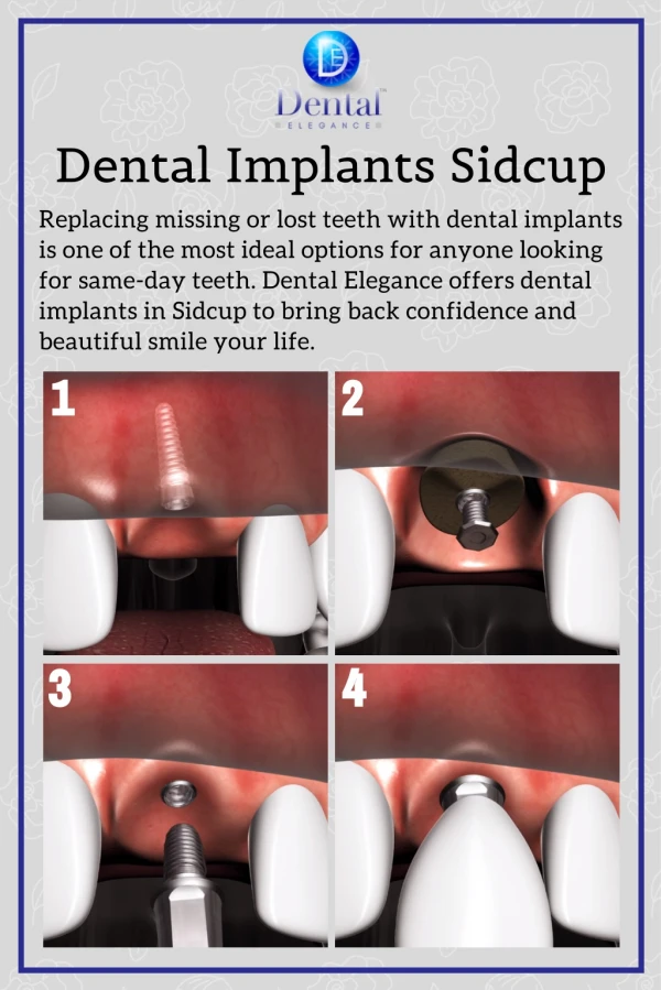 Dental Implants Sidcup