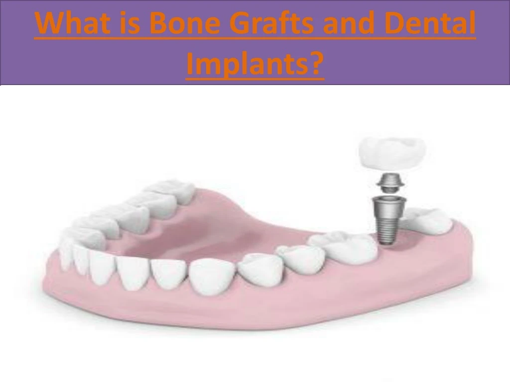 what is bone grafts and dental implants