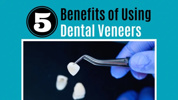 5 Benefits Of Using Dental Veneers