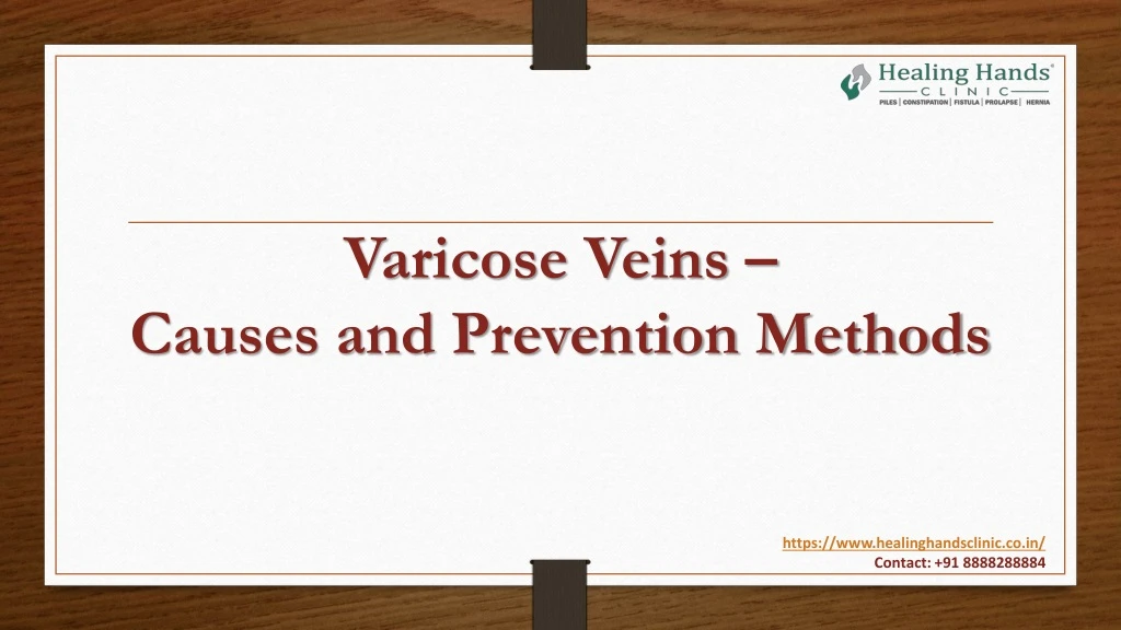 varicose veins causes and prevention methods