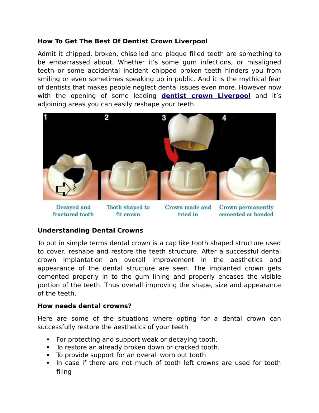 how to get the best of dentist crown liverpool
