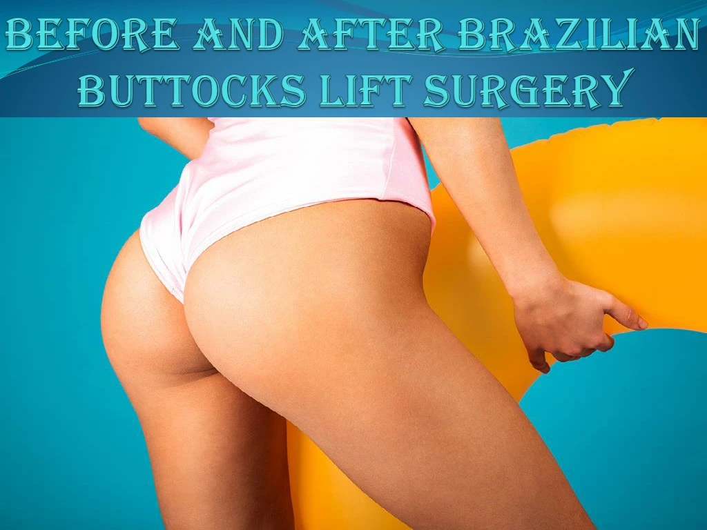 before and after brazilian buttocks lift surgery