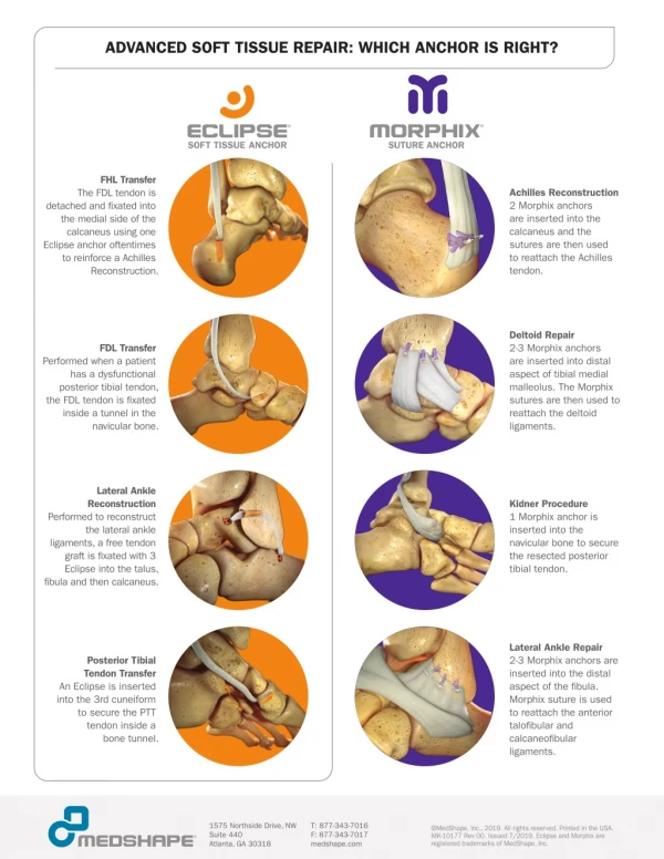 Advanced Soft Tissue Repair - Which Anchor is Right?