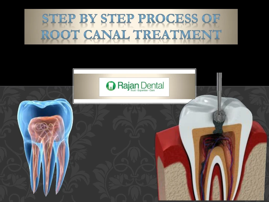 step by step process of root canal treatment