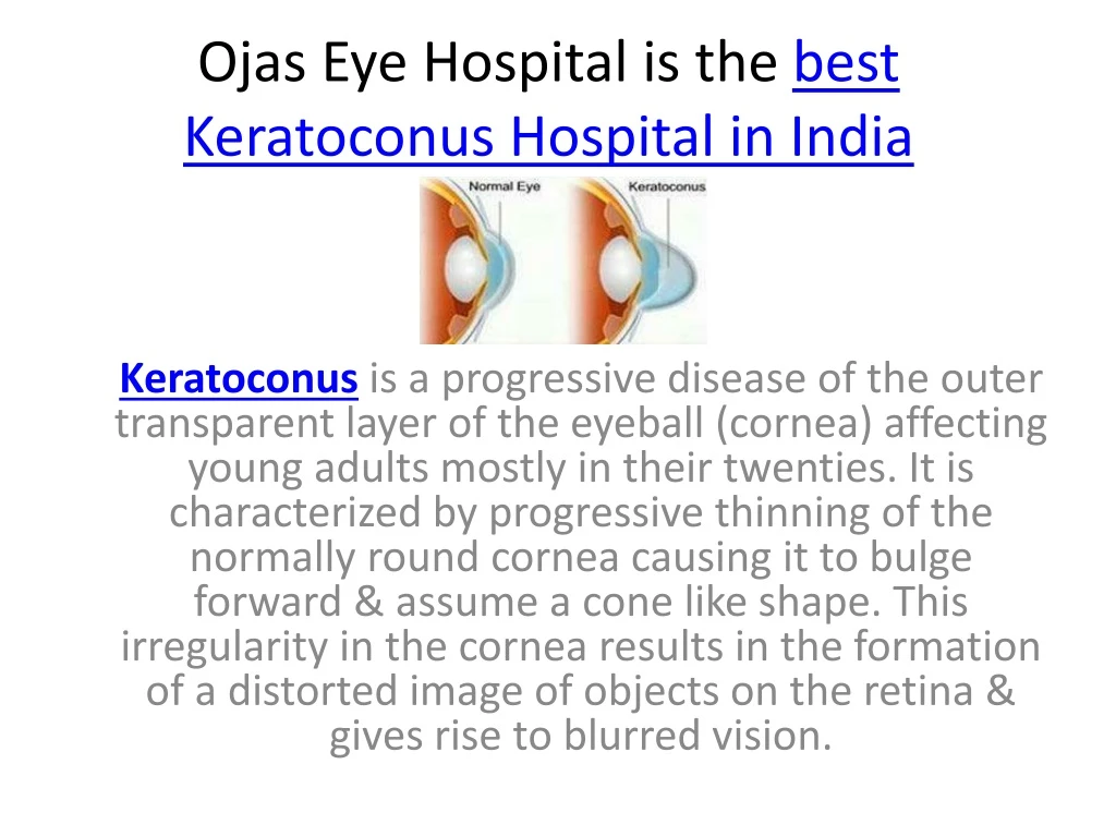ojas eye hospital is the best keratoconus hospital in india