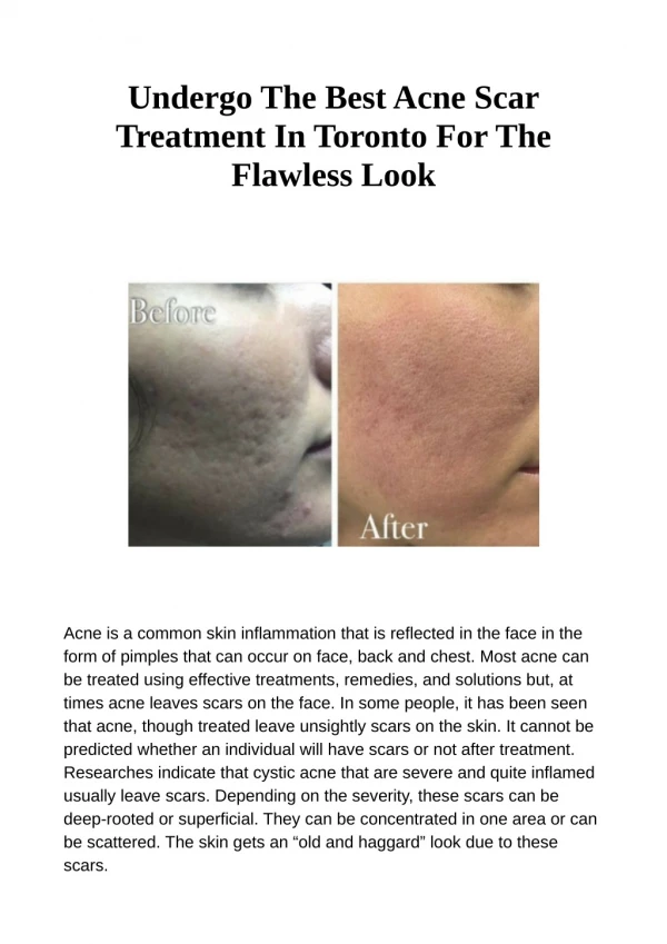 Undergo The Best Acne Scar Treatment In Toronto For The Flawless Look