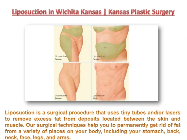 Liposuction in Wichita Kansas | Kansas Plastic Surgery