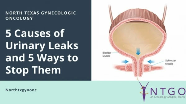 5 Causes Of Urinary Leaks And 5 Ways To Stop Them