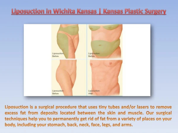 Liposuction in Wichita Kansas | Kansas Plastic Surgery