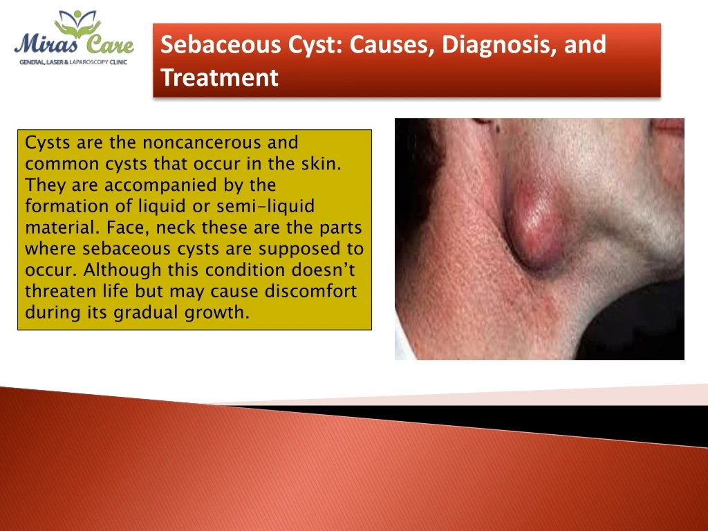 sebaceous cyst causes diagnosis and treatment