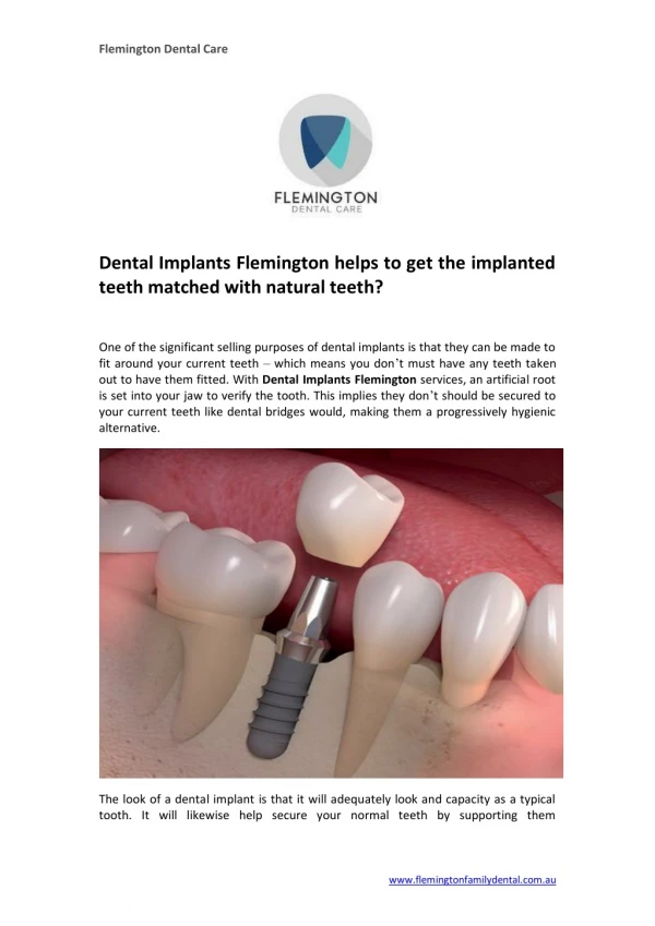 Dental Implants Flemington helps to get the implanted teeth matched with natural teeth?
